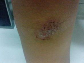 膝盖摔伤图片,揭秘常见运动损伤的紧急处理方法